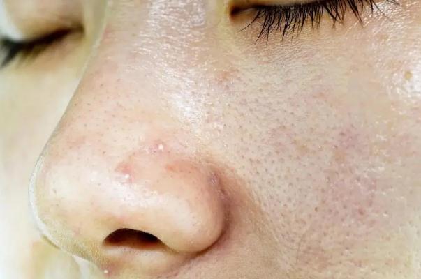 皮膚出油是怎么回事 皮膚出油要補(bǔ)水還是控油 皮膚出油是怎么回事 皮膚出油要補(bǔ)水還是控油