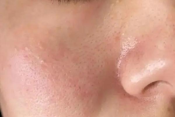 皮膚出油是因為皮膚缺水嗎 皮膚出油是身體哪里出問題了 皮膚出油是因為皮膚缺水嗎 皮膚出油是身體哪里出問題了