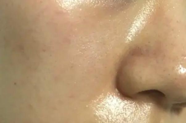 皮膚出油多是什么原因 皮膚出油嚴(yán)重毛孔粗大如何改善 皮膚出油多是什么原因 皮膚出油嚴(yán)重毛孔粗大如何改善