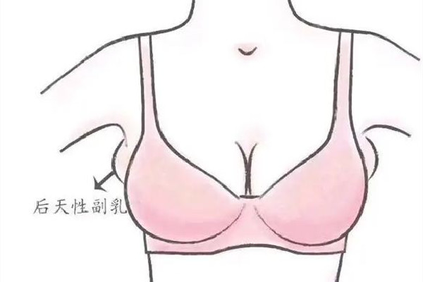 副乳切除手術(shù)是全麻還是局麻 副乳切除手術(shù)后多久可以正?；顒?dòng)