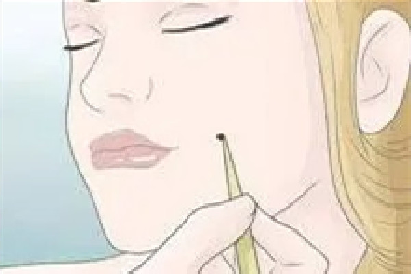 武漢點(diǎn)痣哪家醫(yī)院好 武漢點(diǎn)痣?yún)f(xié)和好還是同濟(jì)好