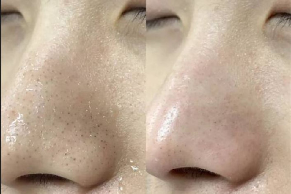 黑頭是怎么形成的原因 黑頭是不是永遠去不掉 黑頭是怎么形成的原因 黑頭是不是永遠去不掉