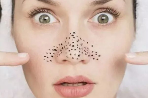 黑頭是怎么形成的原因 黑頭是不是永遠去不掉 黑頭是怎么形成的原因 黑頭是不是永遠去不掉