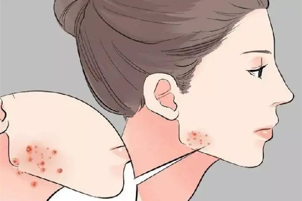 武漢看痘痘去什么醫(yī)院最好 武漢看痘痘可以用醫(yī)保嗎 武漢看痘痘去什么醫(yī)院最好 武漢看痘痘可以用醫(yī)保嗎