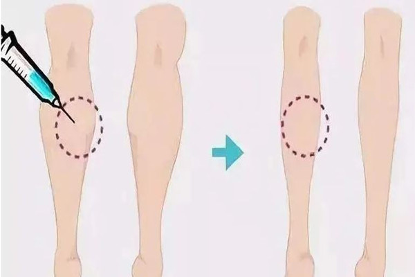 武漢打瘦腿針的醫(yī)院推薦 武漢打瘦腿針要多少錢 武漢打瘦腿針的醫(yī)院推薦 武漢打瘦腿針要多少錢