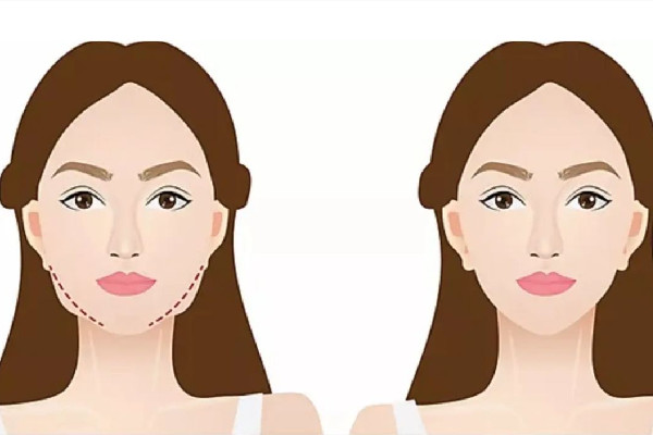 武漢瘦臉針在哪里打比較好 武漢瘦臉針價(jià)格多少錢