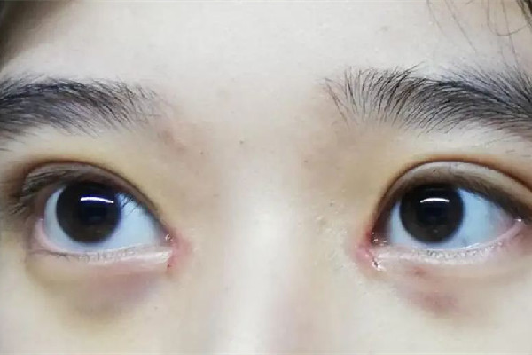 武漢開眼角最好的醫(yī)院 武漢開眼角手術(shù)一般需要多少錢 武漢開眼角最好的醫(yī)院 武漢開眼角手術(shù)一般需要多少錢