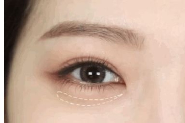 武漢填充臥蠶哪家好 武漢臥蠶手術(shù)哪個醫(yī)院做的好 武漢填充臥蠶哪家好 武漢臥蠶手術(shù)哪個醫(yī)院做的好