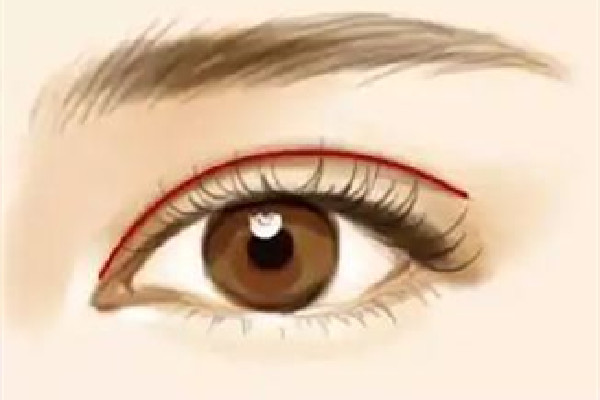 武漢眼瞼下垂手術(shù)哪個(gè)做的好 武漢眼瞼下垂手術(shù)要多少錢(qián) 武漢眼瞼下垂手術(shù)哪個(gè)做的好 武漢眼瞼下垂手術(shù)要多少錢(qián)