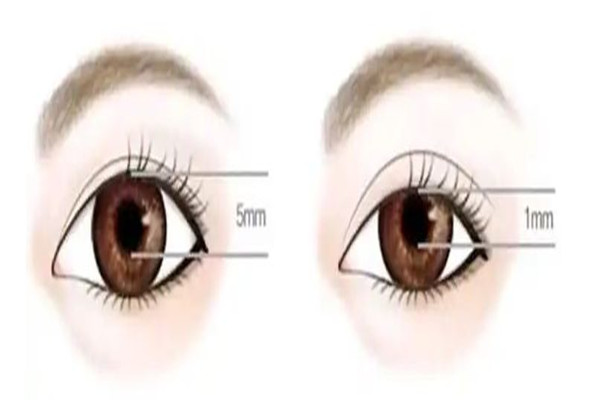 武漢眼部提拉哪里好 武漢眼部提拉手術(shù)多少錢 武漢眼部提拉哪里好 武漢眼部提拉手術(shù)多少錢