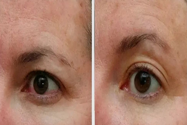 武漢可以做眼部松弛的醫(yī)院 武漢做眼部松弛價格 武漢可以做眼部松弛的醫(yī)院 武漢做眼部松弛價格