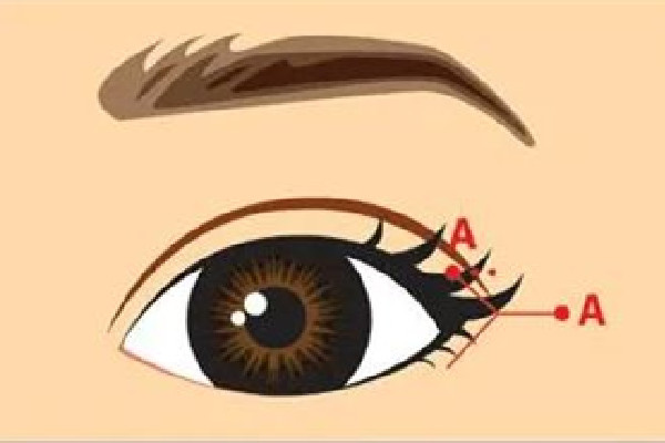 武漢開(kāi)外眼角哪家醫(yī)院好 武漢開(kāi)外眼角多少錢