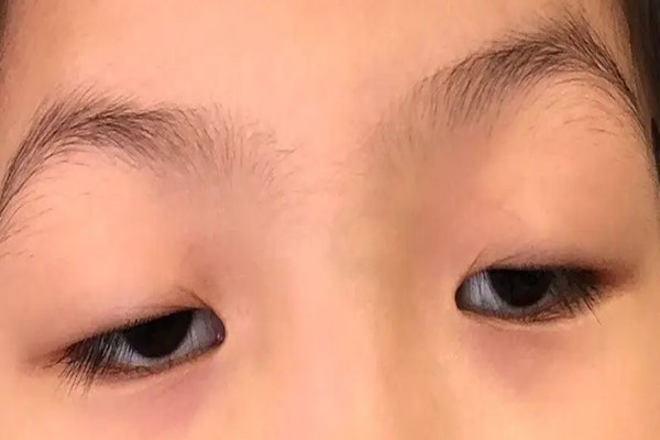 武漢上眼瞼下垂哪個(gè)醫(yī)院做的好 武漢上眼瞼下垂修復(fù)手術(shù)要多少錢(qián)