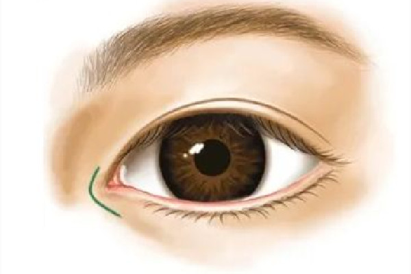 武漢開內(nèi)眼角醫(yī)院 武漢開內(nèi)眼角多少錢 武漢開內(nèi)眼角醫(yī)院 武漢開內(nèi)眼角多少錢