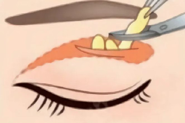 武漢腫眼泡抽脂哪個醫(yī)院好 武漢做腫眼泡抽脂多少錢 武漢腫眼泡抽脂哪個醫(yī)院好 武漢做腫眼泡抽脂多少錢