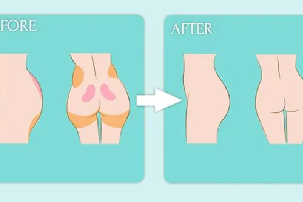 武漢假體臀部整形醫(yī)院 武漢假體臀部整形多少錢(qián) 武漢假體臀部整形醫(yī)院 武漢假體臀部整形多少錢(qián)