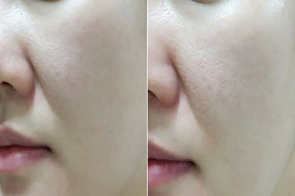 江漢路步行街skin79皮膚管理中心去黑頭效果怎么樣 江漢路步行街skin79皮膚管理中心可以深層清潔嗎