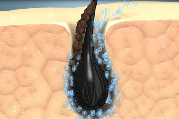 光谷W·SKIN皮膚管理中心毛孔清潔做的好嗎 光谷W·SKIN皮膚管理