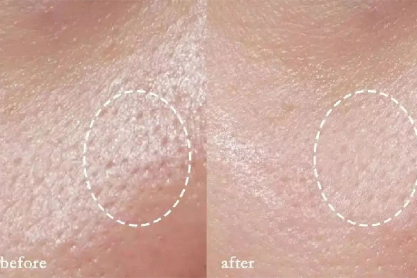 光谷瑞妮可思·科技抗衰中心修復(fù)肌膚效果怎么樣 修復(fù)肌膚屏障一般需要多久 光谷瑞妮可思·科技抗衰中心修復(fù)肌膚效果怎么樣 修復(fù)肌膚屏障一般需要多久