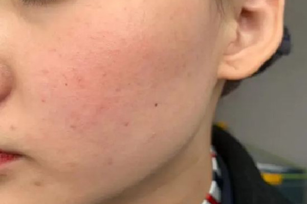 光谷MG問題皮膚管理中心痘痘肌護(hù)理怎么樣 痘痘肌膚適合什么面膜 光谷MG問題皮膚管理中心痘痘肌護(hù)理怎么樣 痘痘肌膚適合什么面膜