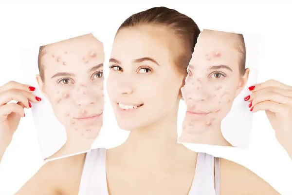 光谷美顏蜜肌皮膚管理中心做完小氣泡之后效果好嗎 小氣泡可以經(jīng)常做嗎 光谷美顏蜜肌皮膚管理中心做完小氣泡之后效果好嗎 小氣泡可以經(jīng)常做嗎