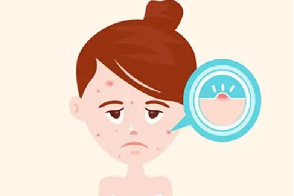 光谷天地傾顏皮膚管理中心痘痘肌護理效果怎么樣 痘痘肌多久可以改善過來 光谷天地傾顏皮膚管理中心痘痘肌護理效果怎么樣 痘痘肌多久可以改善過來