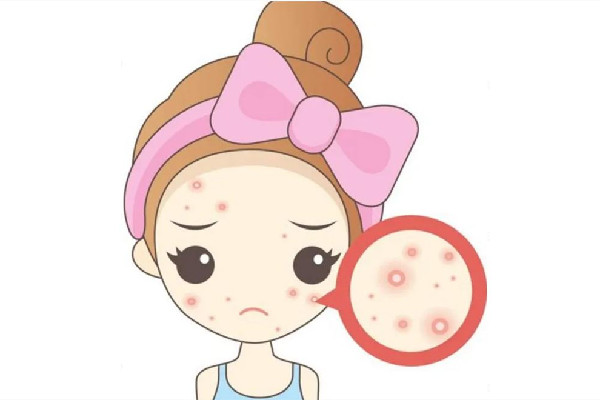 光谷天地傾顏皮膚管理中心痘痘肌護理效果怎么樣 痘痘肌多久可以改善過來 光谷天地傾顏皮膚管理中心痘痘肌護理效果怎么樣 痘痘肌多久可以改善過來