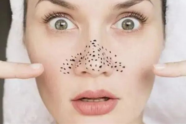 光谷天地傾顏皮膚管理中心去黑頭專業(yè)嗎 去黑頭會(huì)不會(huì)越來(lái)越嚴(yán)重 光谷天地傾顏皮膚管理中心去黑頭專業(yè)嗎 去黑頭會(huì)不會(huì)越來(lái)越嚴(yán)重