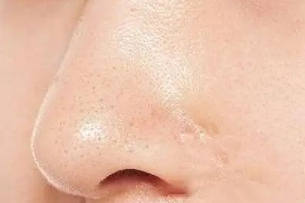 光谷天地美伽皮膚管理中心收縮毛孔效果好不好 收縮毛孔可以用水楊酸嗎 光谷天地美伽皮膚管理中心收縮毛孔效果好不好 收縮毛孔可以用水楊酸嗎