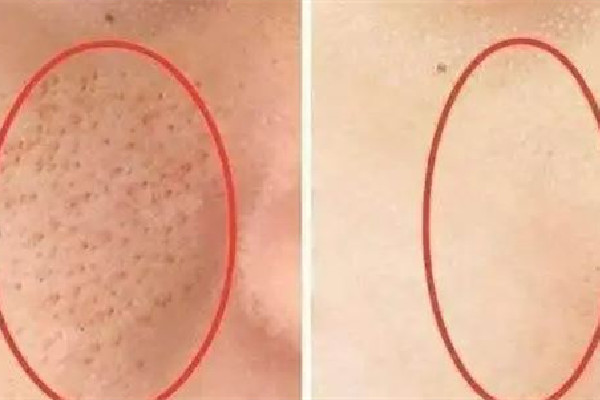 光谷天地美伽皮膚管理中心收縮毛孔效果好不好 收縮毛孔可以用水楊酸嗎 光谷天地美伽皮膚管理中心收縮毛孔效果好不好 收縮毛孔可以用水楊酸嗎