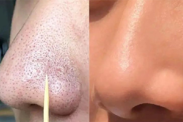 菱角湖SOR索爾祛痘?面部肌膚科學(xué)管理去黑頭效果怎么樣 去黑頭會留疤嗎 菱角湖SOR索爾祛痘?面部肌膚科學(xué)管理去黑頭效果怎么樣 去黑頭會留疤嗎