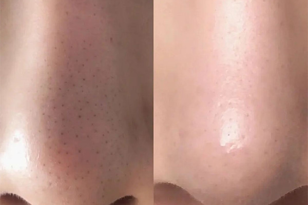 菱角湖SOR索爾祛痘?面部肌膚科學(xué)管理去黑頭效果怎么樣 去黑頭會留疤嗎 菱角湖SOR索爾祛痘?面部肌膚科學(xué)管理去黑頭效果怎么樣 去黑頭會留疤嗎