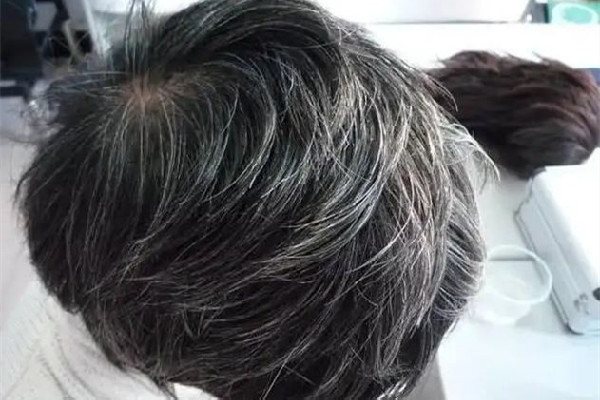 白頭發(fā)吃中藥能調(diào)理好嗎 白頭發(fā)多久能變黑 白頭發(fā)吃中藥能調(diào)理好嗎 白頭發(fā)多久能變黑