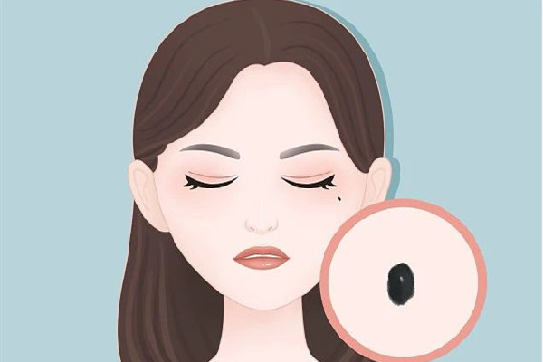 中南路正璞醫(yī)療美容·痘坑疤痕&皮膚微整店可以去痣嗎 祛痣要多久才能恢復(fù) 中南路正璞醫(yī)療美容·痘坑疤痕&皮膚微整店可以去痣嗎 祛痣要多久才能恢復(fù)