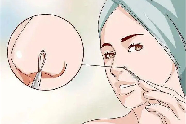 中南路蕾特恩專業(yè)祛痘·面部皮膚管理店去黑頭后效果怎么樣 去黑頭后怎么護(hù)理 中南路蕾特恩專業(yè)祛痘·面部皮膚管理店去黑頭后效果怎么樣 去黑頭后怎么護(hù)理