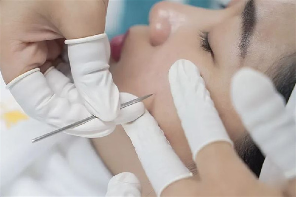 后湖SOR索爾祛痘?面部肌膚科學(xué)管理針清效果怎么樣 針清會讓毛孔變大嗎 后湖SOR索爾祛痘?面部肌膚科學(xué)管理針清效果怎么樣 針清會讓毛孔變大嗎