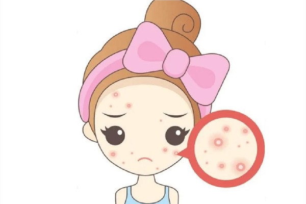 后湖SOR索爾祛痘?面部肌膚科學(xué)管理痘肌清潔做的怎么樣 痘肌怎么清潔皮膚 后湖SOR索爾祛痘?面部肌膚科學(xué)管理痘肌清潔做的怎么樣 痘肌怎么清潔皮膚