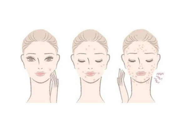 后湖SOR索爾祛痘?面部肌膚科學(xué)管理痘肌清潔做的怎么樣 痘肌怎么清潔皮膚 后湖SOR索爾祛痘?面部肌膚科學(xué)管理痘肌清潔做的怎么樣 痘肌怎么清潔皮膚