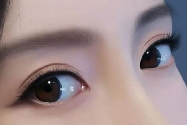 五旬男子因剛割雙眼皮開車撞上護欄 雙眼皮割完后要注意的問題有哪些 五旬男子因剛割雙眼皮開車撞上護欄 雙眼皮割完后要注意的問題有哪些