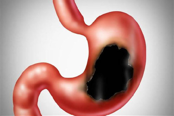 為什么年輕人胃病高發(fā) 胃病有什么癥狀及表現 為什么年輕人胃病高發(fā) 胃病有什么癥狀及表現