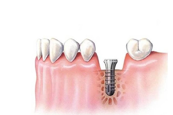多地調(diào)低種植牙醫(yī)療服務(wù)費(fèi)用 種牙醫(yī)保能報(bào)銷嗎 多地調(diào)低種植牙醫(yī)療服務(wù)費(fèi)用 種牙醫(yī)保能報(bào)銷嗎