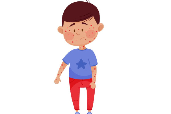 水痘進(jìn)入高發(fā)期專家提醒 水痘的癥狀和治療 水痘進(jìn)入高發(fā)期專家提醒 水痘的癥狀和治療